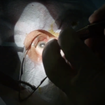 Why I got Eye Surgery on One Eye Only